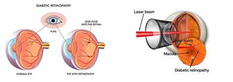 Лазерная коагуляция глазного дна